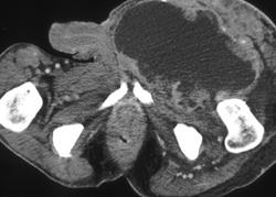 Ulcerating Sarcoma - CTisus CT Scan