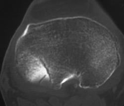 Tibial Plateau Fracture - CTisus CT Scan