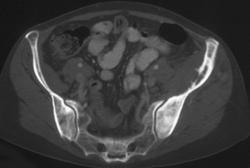 Lymphoma Left Iliac Wing - CTisus CT Scan