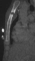 Osteomyelitis of the Manubrial Sternal Joint - CTisus CT Scan