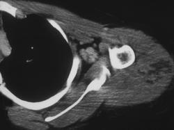 Intramuscular Abscess - CTisus CT Scan