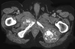 Metastatic Prostate Cancer - CTisus CT Scan