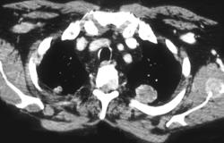 Metastatic Renal Cell Carcinoma to Muscle and Bone - CTisus CT Scan