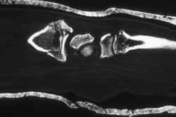 Distal Radial Fracture - CTisus CT Scan