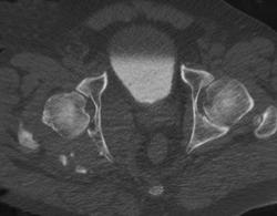 S/P Reduction of Left Hip Dislocation - CTisus CT Scan