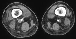 Popliteal Vein Thrombosis - CTisus CT Scan