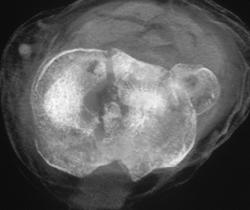 Tibial Plateau Fracture - CTisus CT Scan