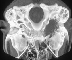 Primary Tumor of the Skull Base - CTisus CT Scan