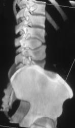 Scoliosis With Congenitally Deformed Vertebral Bodies - CTisus CT Scan