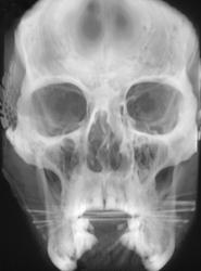 Trauma to Right Eye With A Patch - CTisus CT Scan