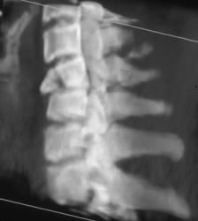 Compression Fracture of C-4 - CTisus CT Scan