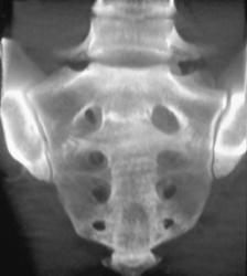 Metastases to the Sacrum - CTisus CT Scan