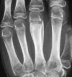 Osteomyelitis - CTisus CT Scan