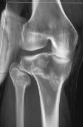 Tibial Plateau Fracture - CTisus CT Scan