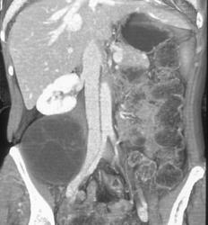 Liposarcoma- Right Lower Quadrant - CTisus CT Scan