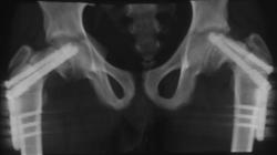 Slipped Capital Femoral Epiphysis (SCFE) Repair With Pins - CTisus CT Scan