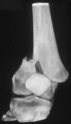 Distal Femur Fracture - CTisus CT Scan