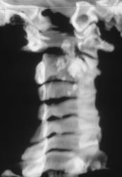 Metastases to the Spinal Cord - CTisus CT Scan