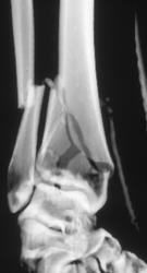 Distal Tibia and Fibula Fracture - CTisus CT Scan