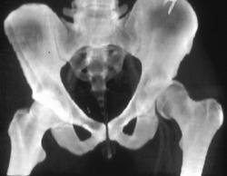 Hip Fracture/dislocation - CTisus CT Scan