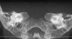 Normal Temporal Bones - CTisus CT Scan