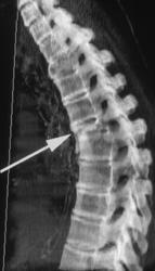 Collapsed Vertebrae in T-spine - CTisus CT Scan