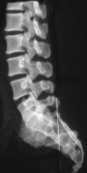 Normal L-spine - CTisus CT Scan