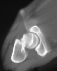 Femur Fracture - CTisus CT Scan