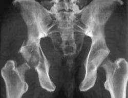 Acetabular Fracture - CTisus CT Scan