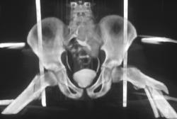 Pelvic and Femur Fractures - CTisus CT Scan