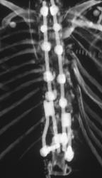 Metal Rods in Spine - CTisus CT Scan