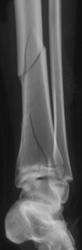 Spiral Tibial Fracture - CTisus CT Scan