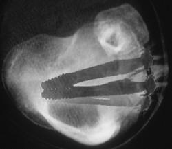 Pins in Tibial Plateau Fracture - CTisus CT Scan