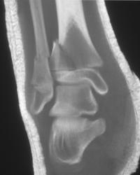 Spiral Tibial and Fibular Fractures - CTisus CT Scan