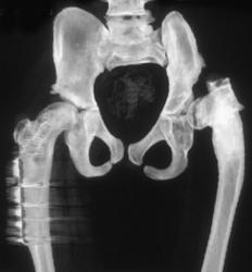 Osteogenisis Imperfecta - CTisus CT Scan