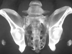 Sacral Fracture - CTisus CT Scan