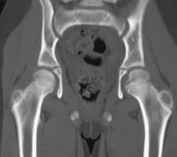 Sclerosis of Left Sacroiliac Joint Due to Lyme Disease - CTisus CT Scan