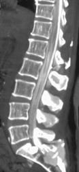 3D CT Myelogram - CTisus CT Scan