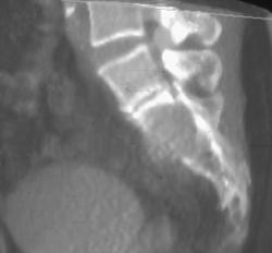 Metastases to Sacrum - CTisus CT Scan