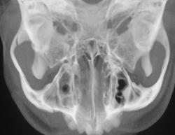 Zygomatic Arch Fracture - CTisus CT Scan