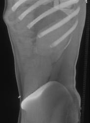 Prominent Costal Cartilage Joint - CTisus CT Scan