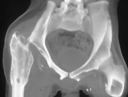 Failed Total Hip Replacement- Pre-op Planning - CTisus CT Scan