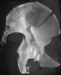 Iliac Wing Acetabular Fracture - CTisus CT Scan