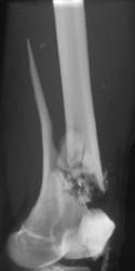 Femur Fracture - CTisus CT Scan