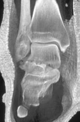 Talus Fracture - CTisus CT Scan