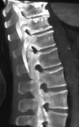 Degenerative Joint Disease (DJD) Spine - CTisus CT Scan