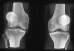 Patellor Dislocation on the Right - CTisus CT Scan