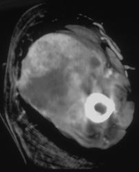 Sarcoma - CTisus CT Scan