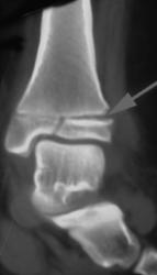 Epiphyseal Plate Fracture and Widening - CTisus CT Scan