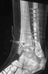 Post-op Study - CTisus CT Scan